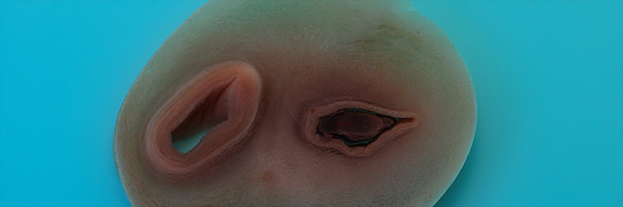 Single Umbilical Artery