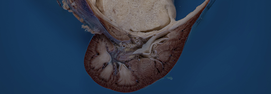 Wilms Tumor (Nephroblastoma)
