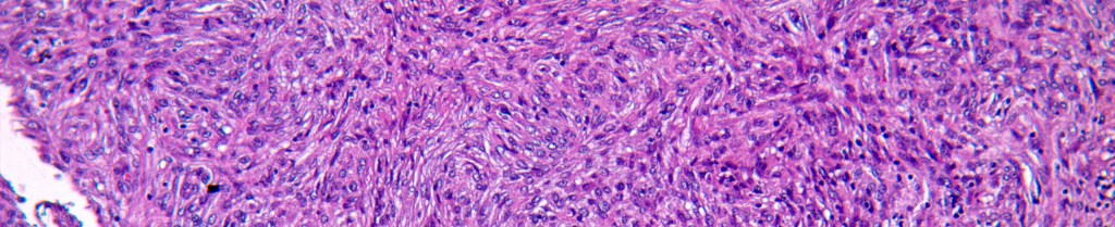 Angiomatous fibrous histiocytoma